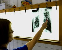 Tuberkolózis riasztás több megyében